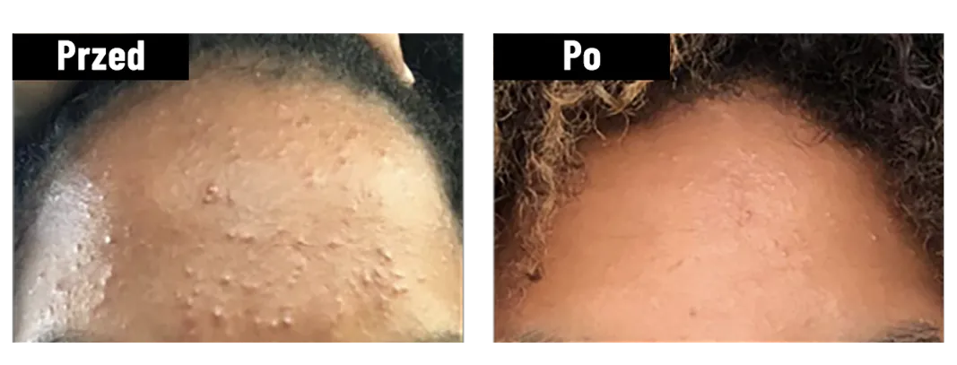 Por&oacute;wnanie sk&oacute;ry przed i po zastosowaniu kremu Yun, widoczne poprawy.