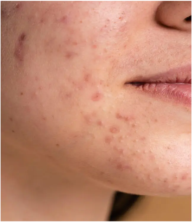 Zbliżenie na sk&oacute;rę twarzy z niedoskonałościami, stan przed użyciem kosmetyk&oacute;w Yun.