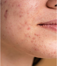 Niedoskonałości skóry twarzy – zbliżenie na zmiany trądzikowe i problemy skórne